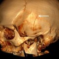 Can CT scan show brain injury