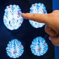Can a brain injury appear years later?