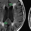 Do old brain lesions appear on MRI?