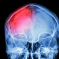 How is mild traumatic brain injury treated?