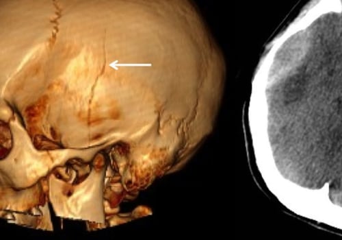 Can CT scan show brain injury