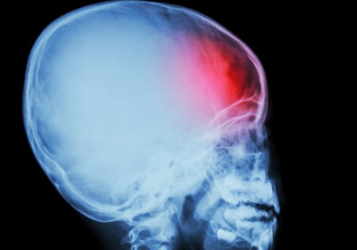 Traumatic brain injury treatment guidelines?