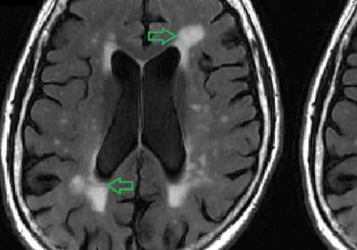 Do old brain lesions appear on MRI?